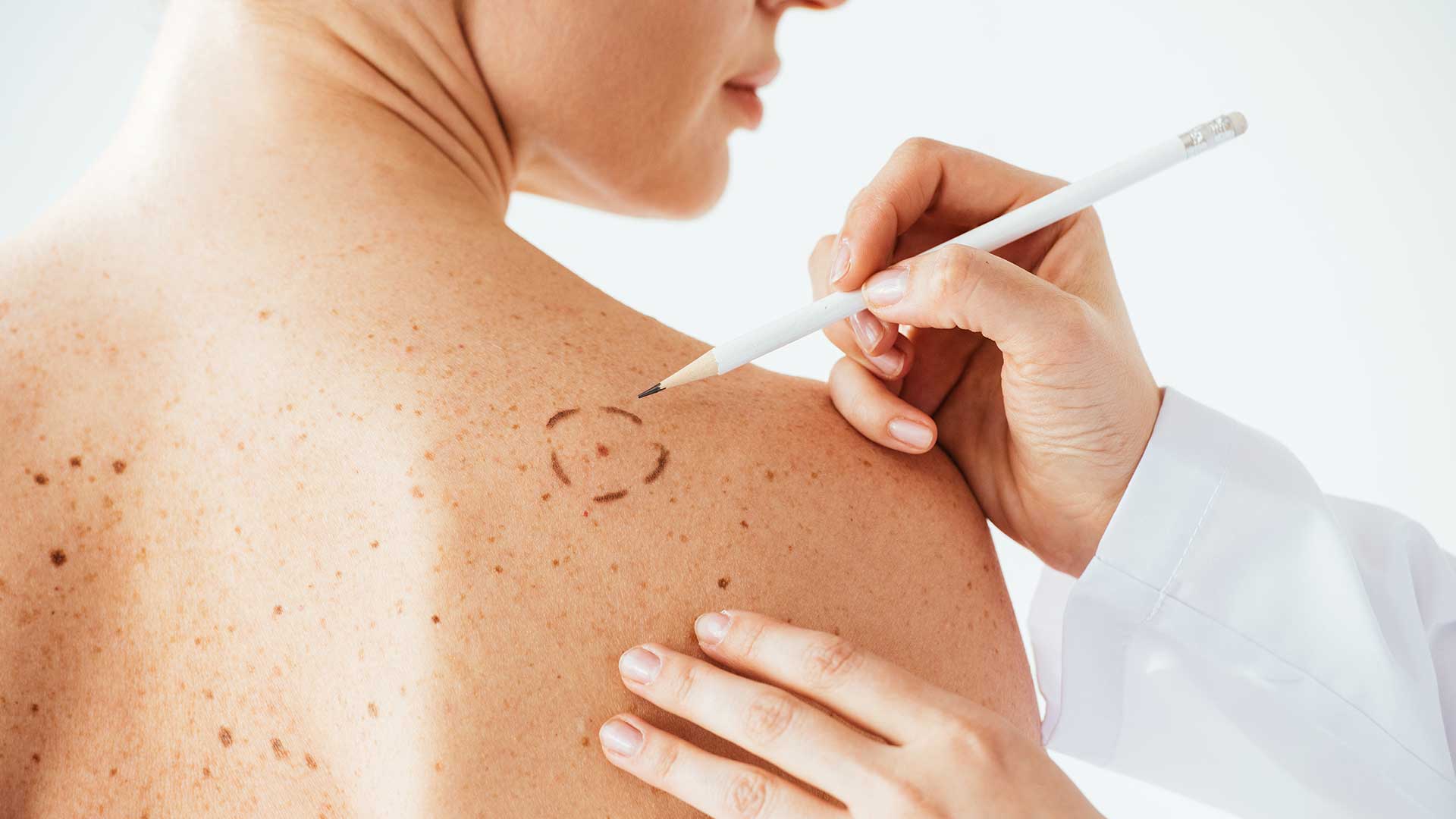 mole-surgical-removal-treatment.jpg